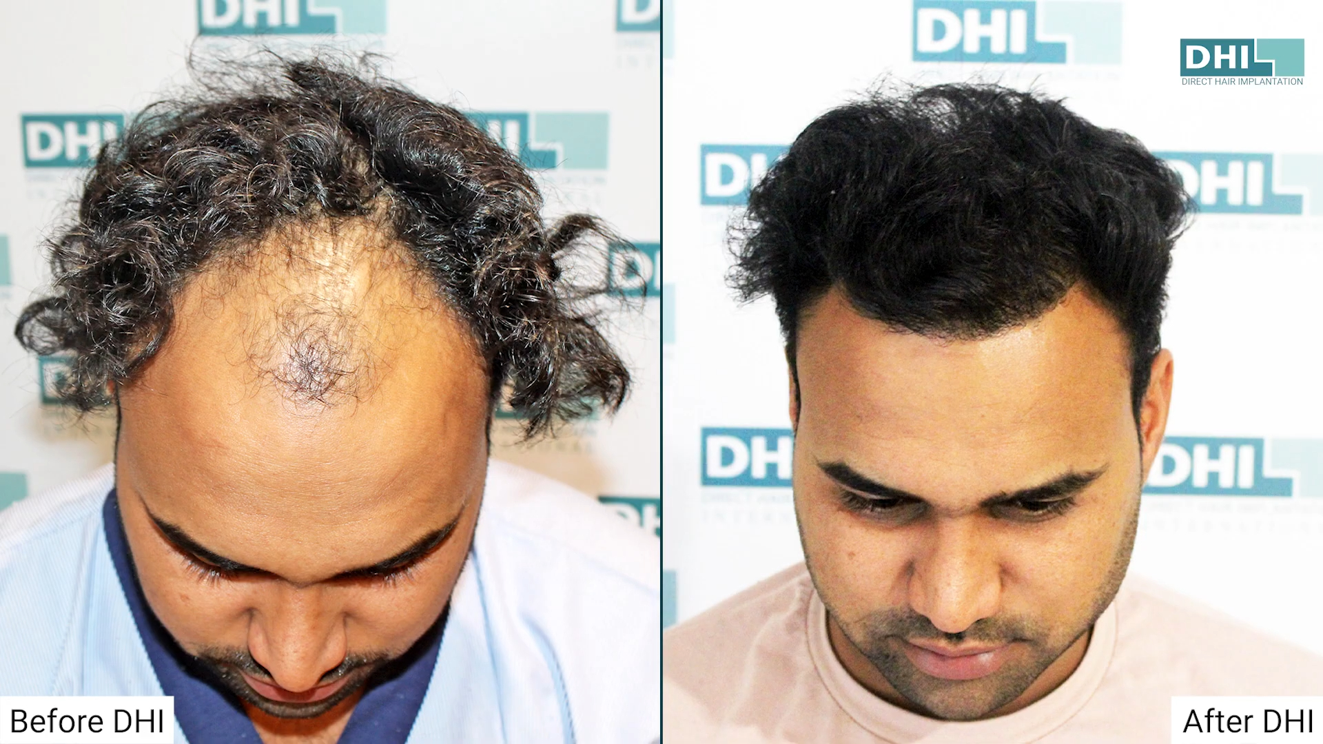 hair transplant video 1