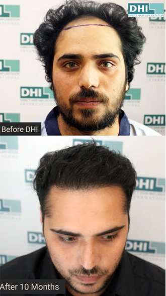 hair transplant video 1