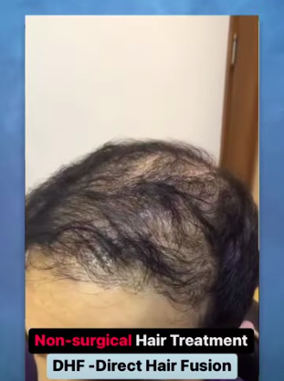 hair transplant video 1