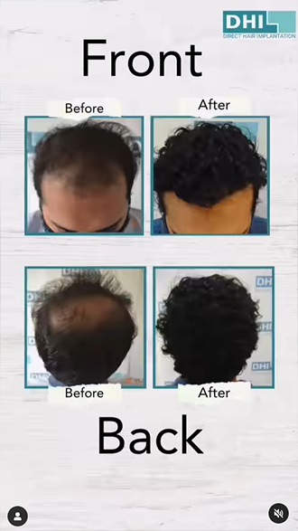 hair transplant video 1