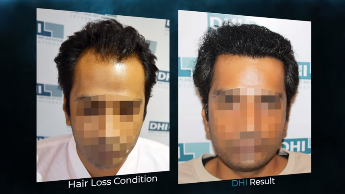 hair transplant video 1