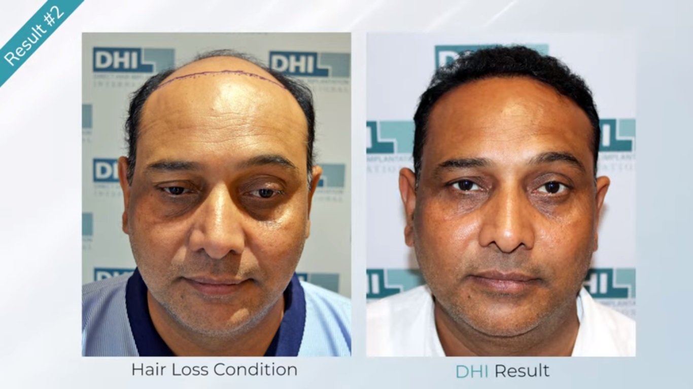 hair transplant video 1