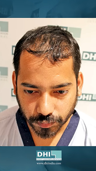 hair transplant video 1