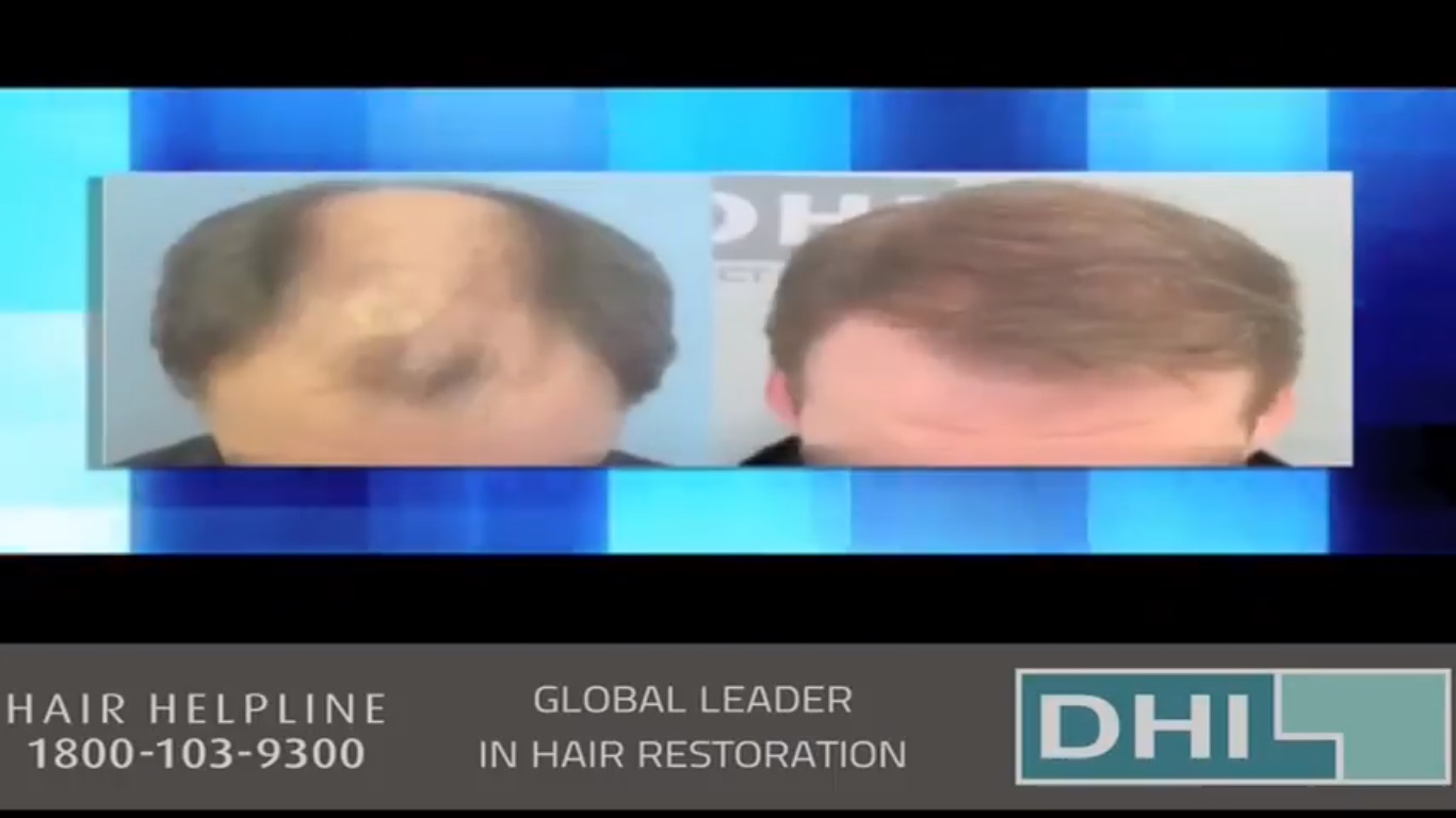 hair transplant video 1