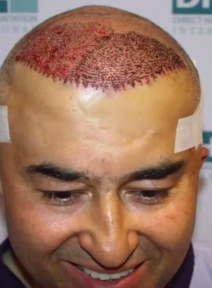 hair transplant video 1