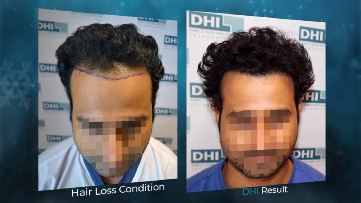 hair transplant video 1