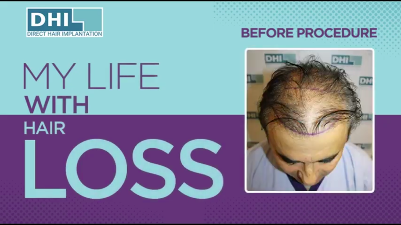 hair transplant video 1