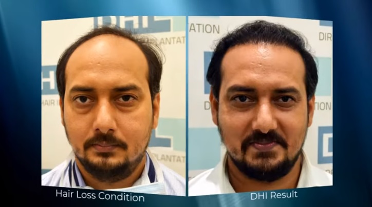 hair transplant video 1