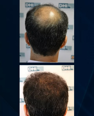 hair transplant video 1