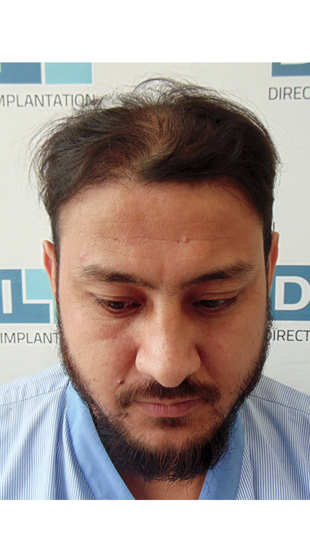 hair transplant video 1