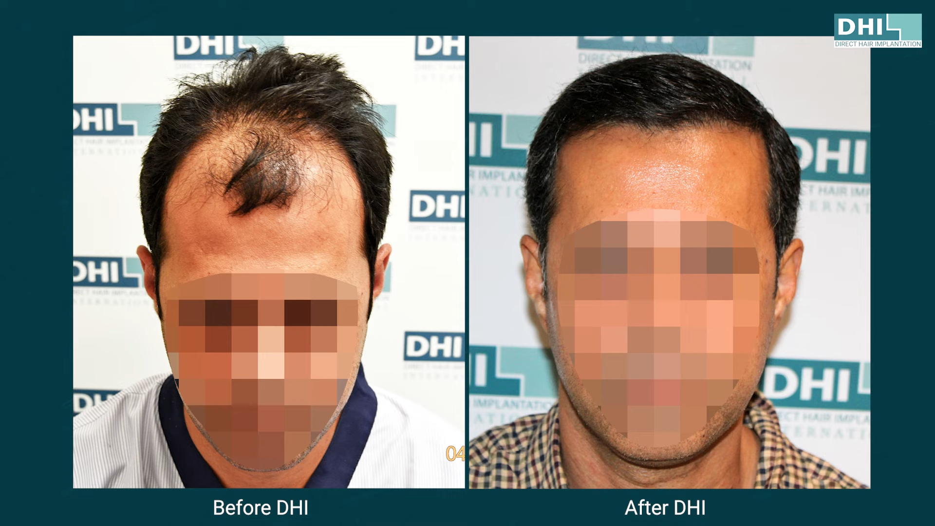 hair transplant video 1