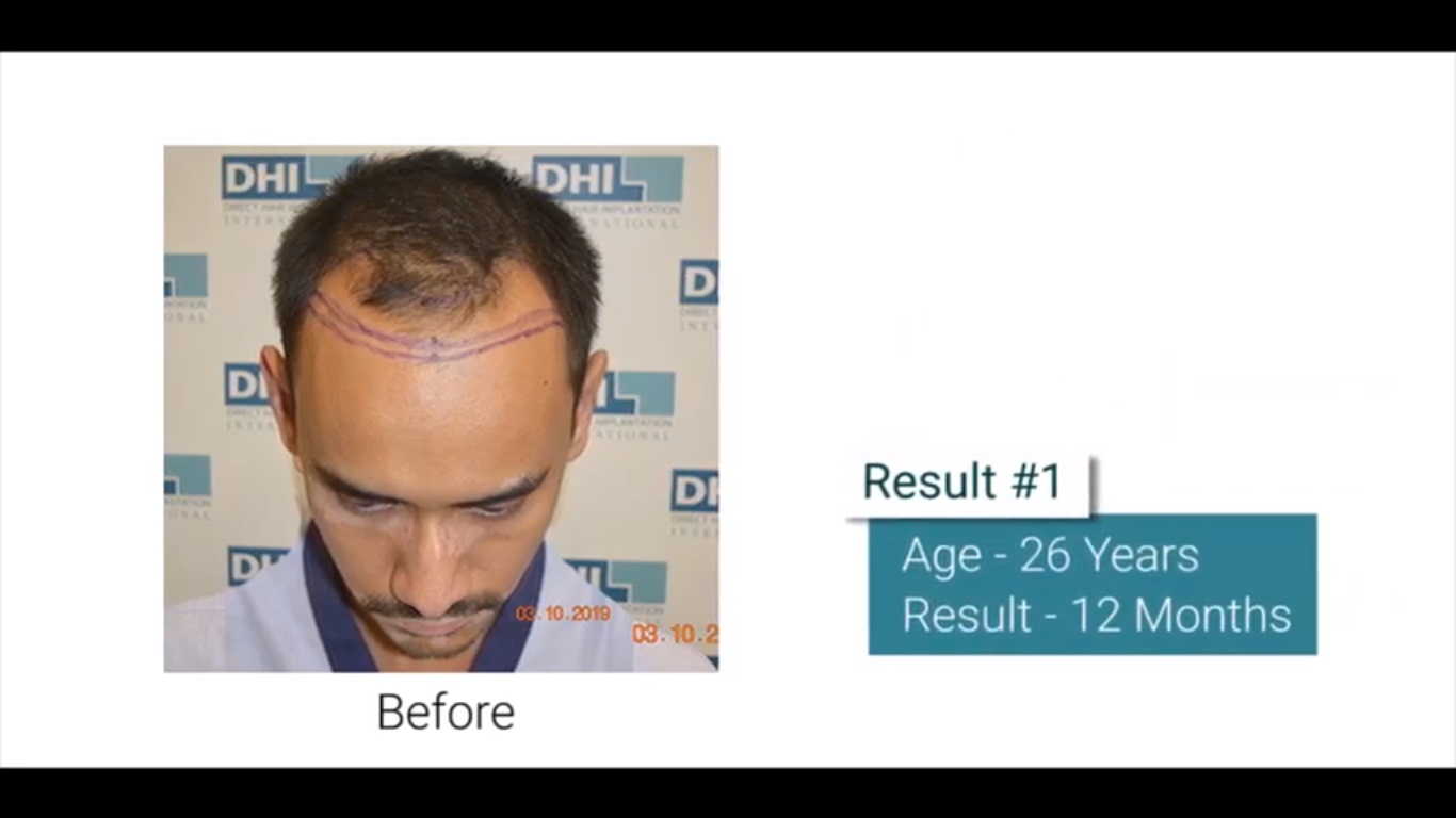 hair transplant video 1