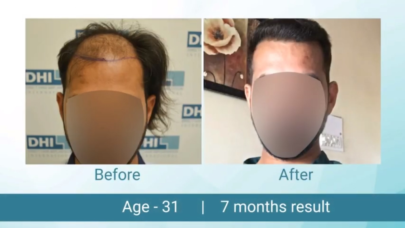 hair transplant video 1