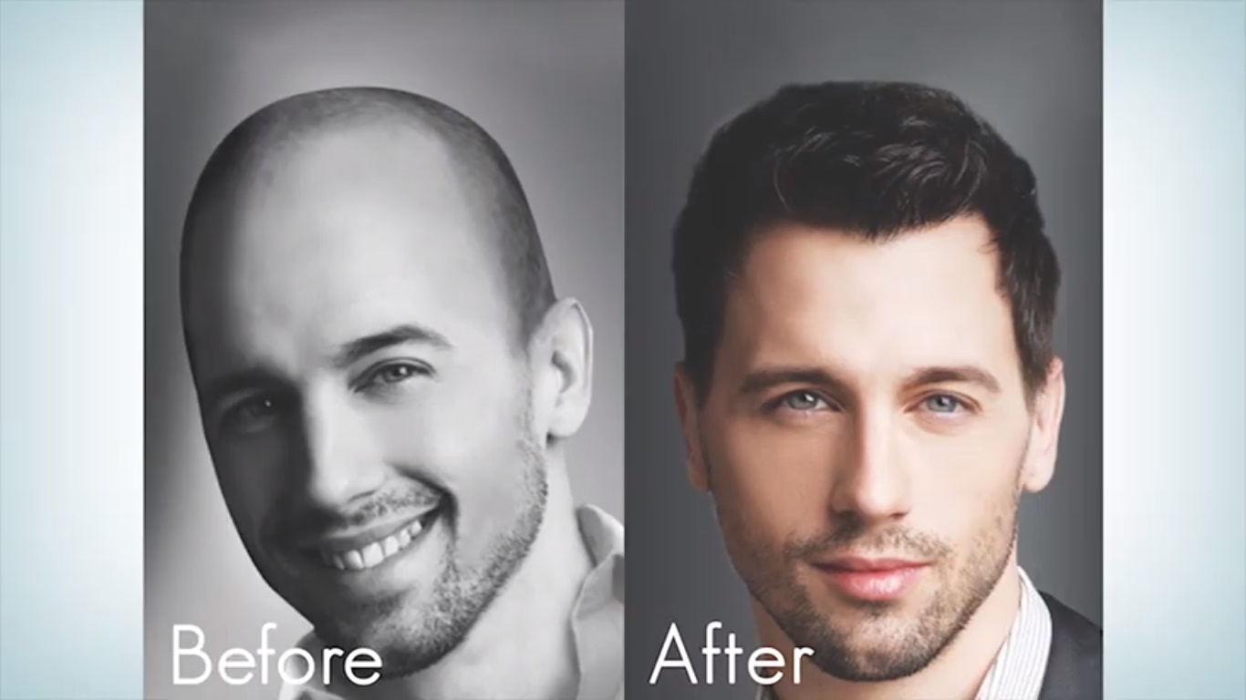 hair transplant video 1