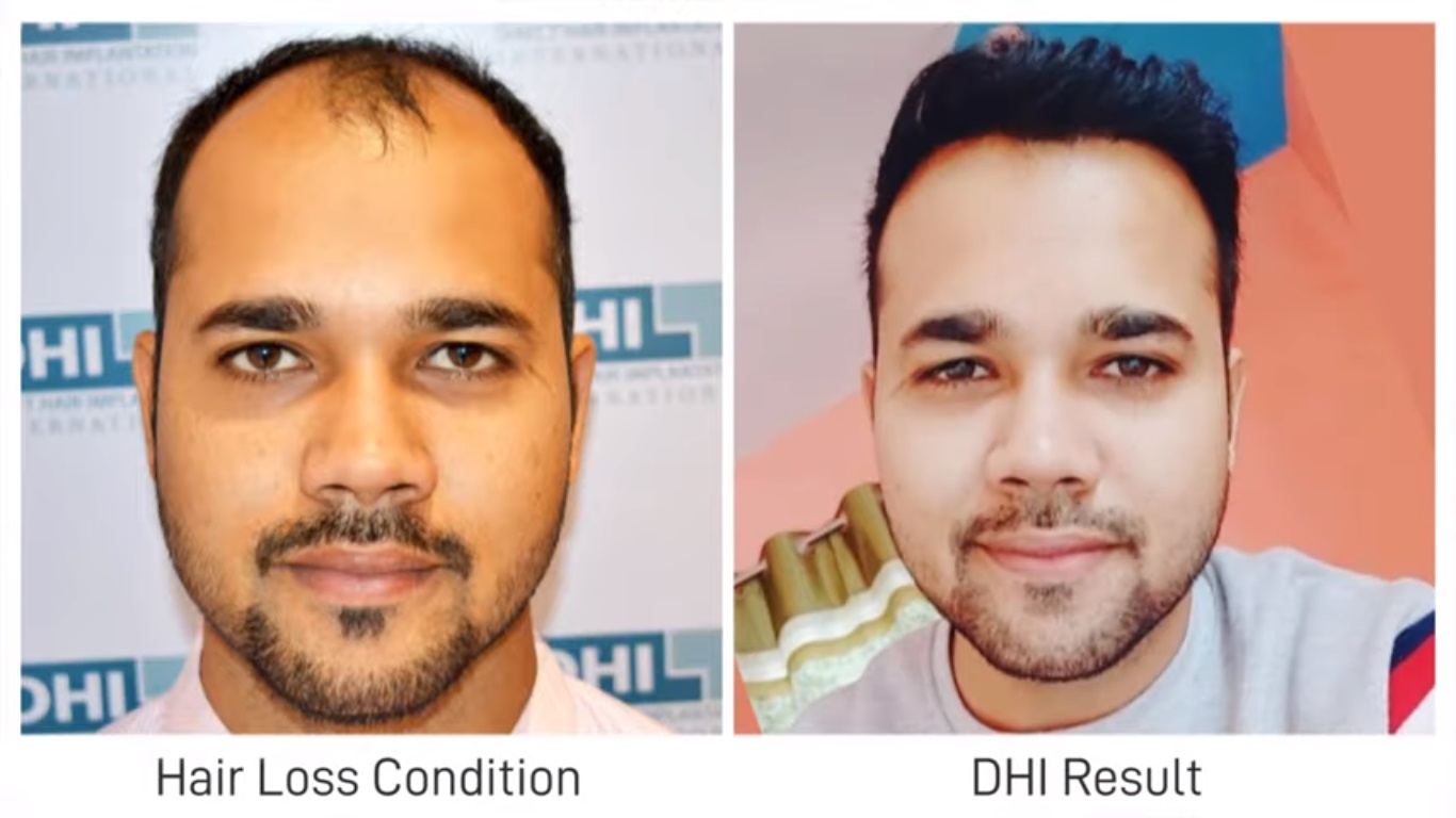 hair transplant video 1