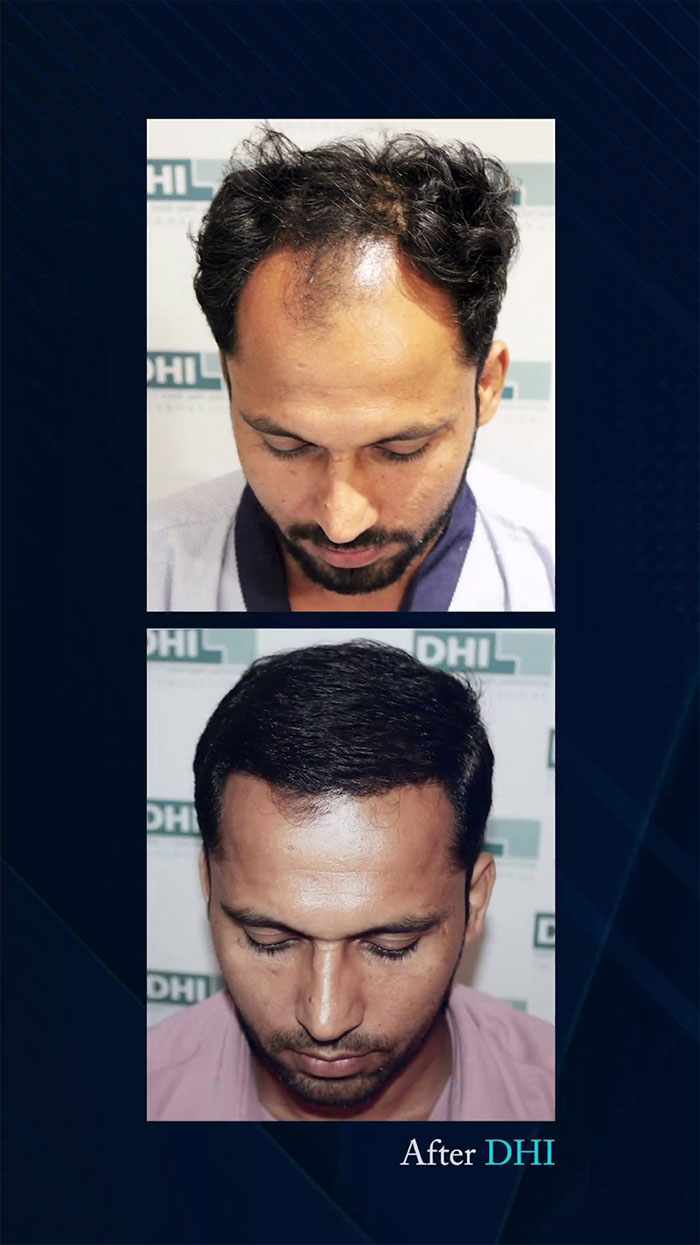 hair transplant video 1