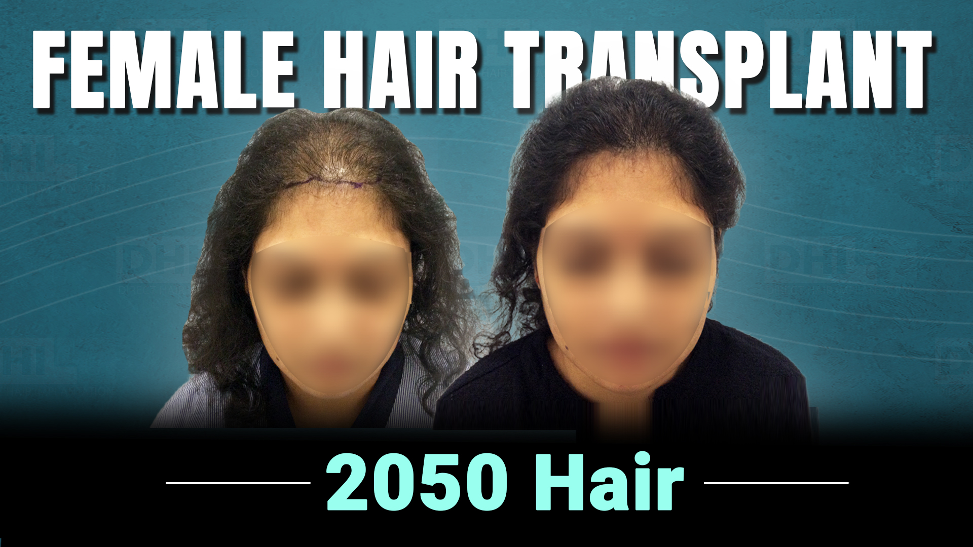 hair transplant video 1