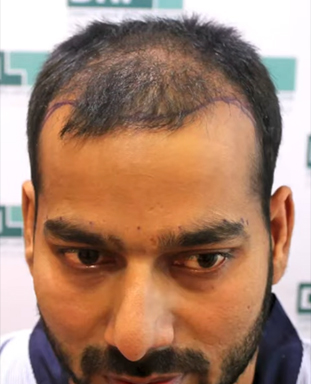 hair transplant video 1