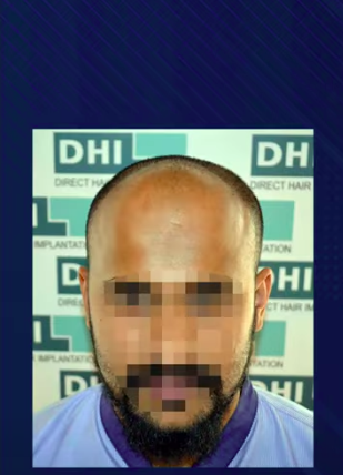 hair transplant video 1