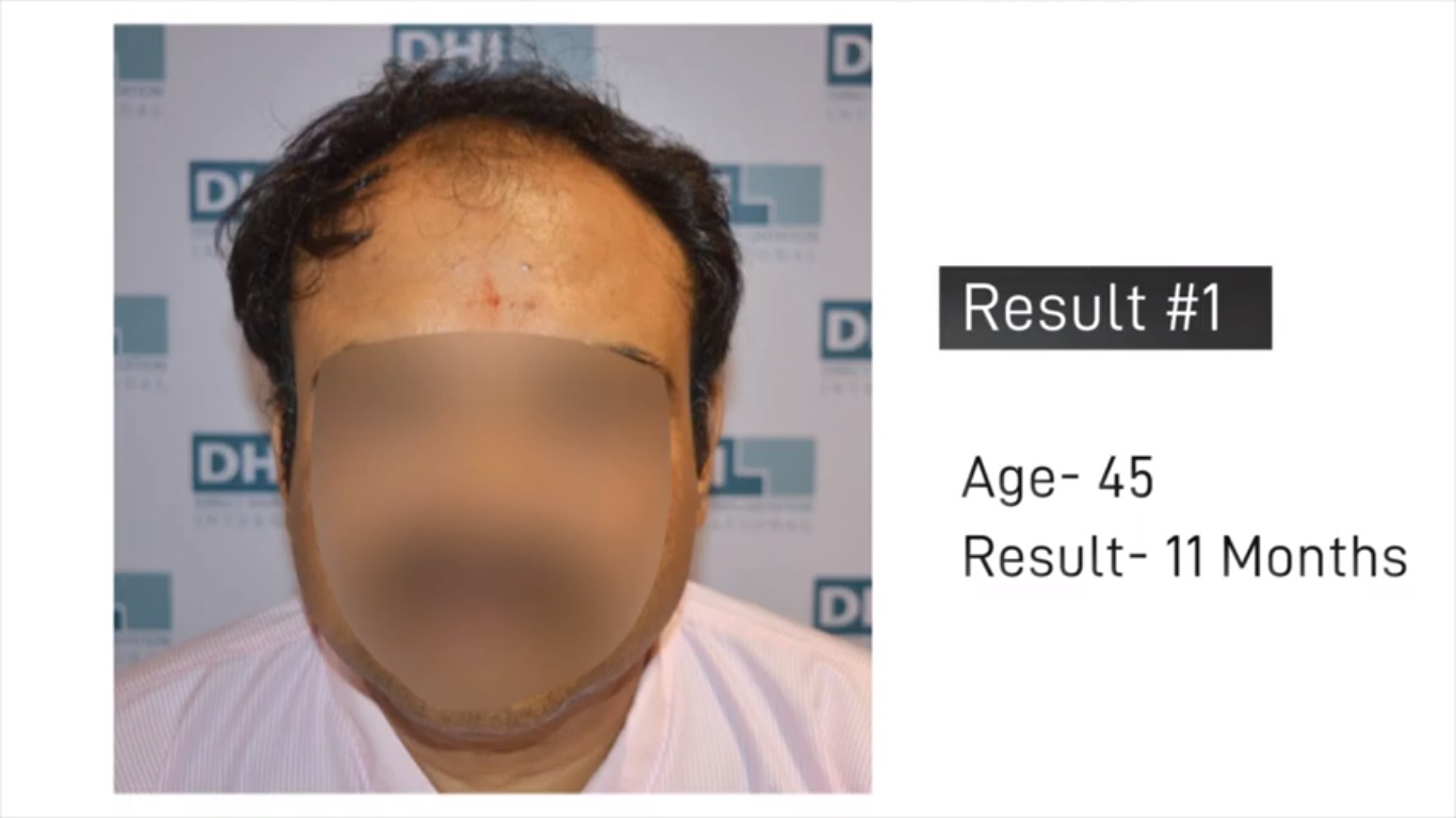 hair transplant video 1