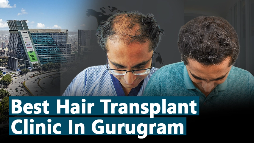 hair transplant video 1