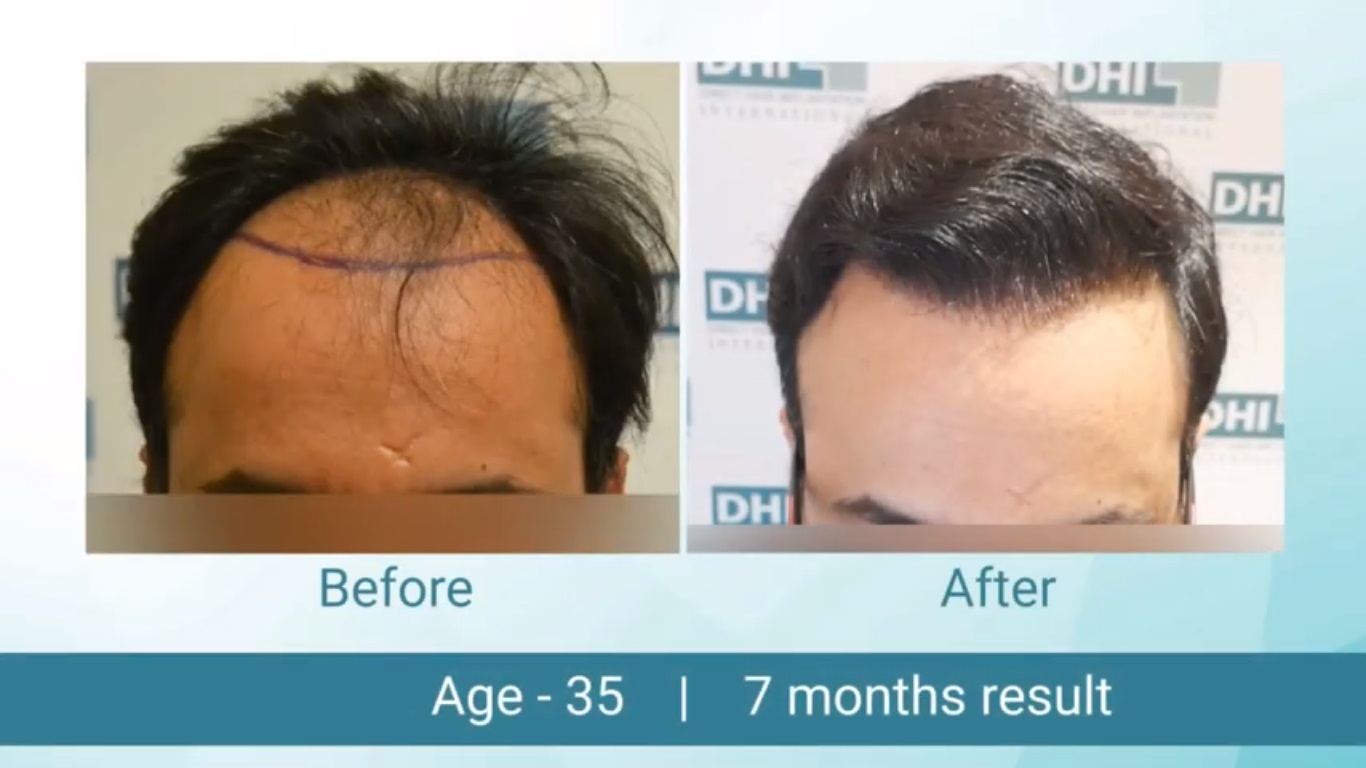 hair transplant video 1