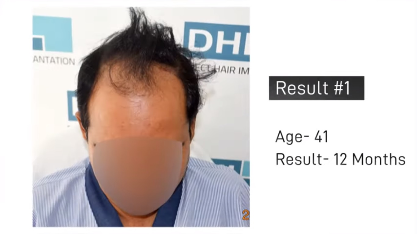 hair transplant video 1