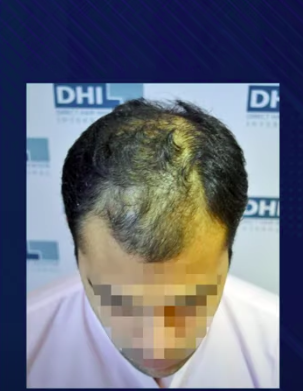 hair transplant video 1