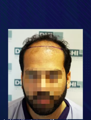 hair transplant video 1