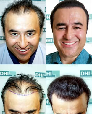 hair transplant video 1