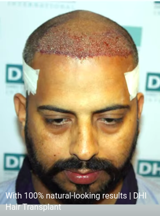 hair transplant video 1