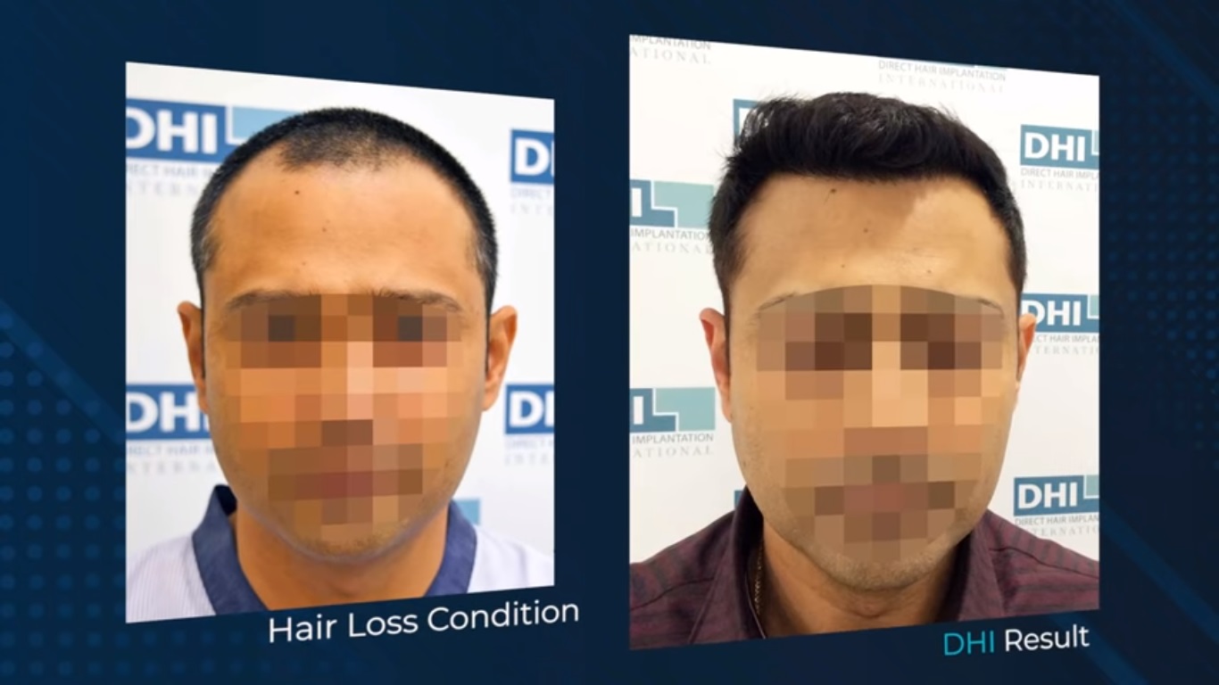 hair transplant video 1