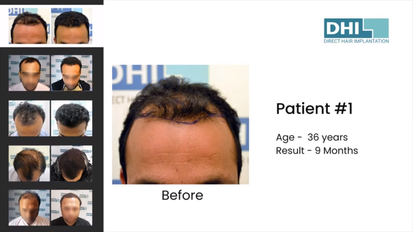 hair transplant video 1