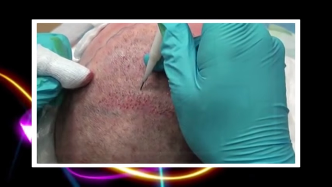 hair transplant video 1