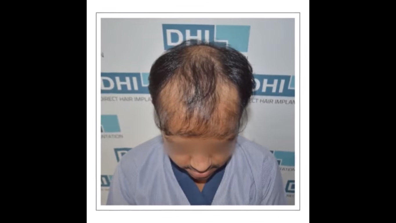 hair transplant video 1