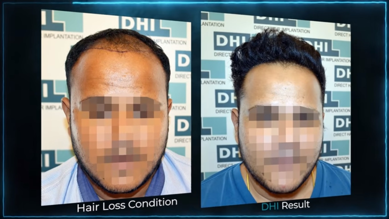 hair transplant video 1