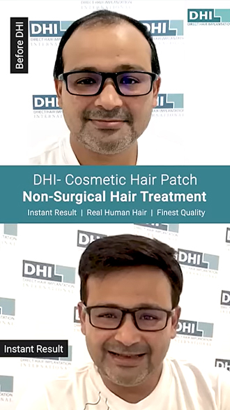 hair transplant video 1