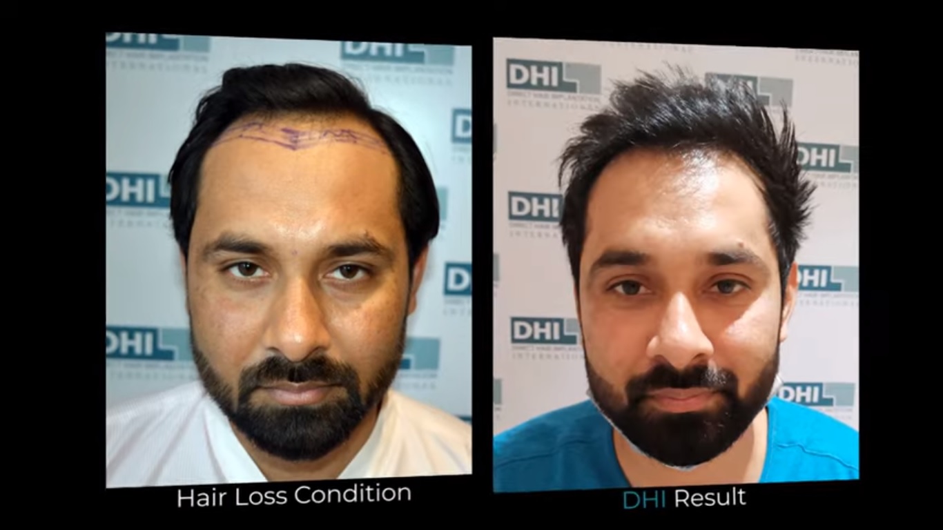 hair transplant video 1