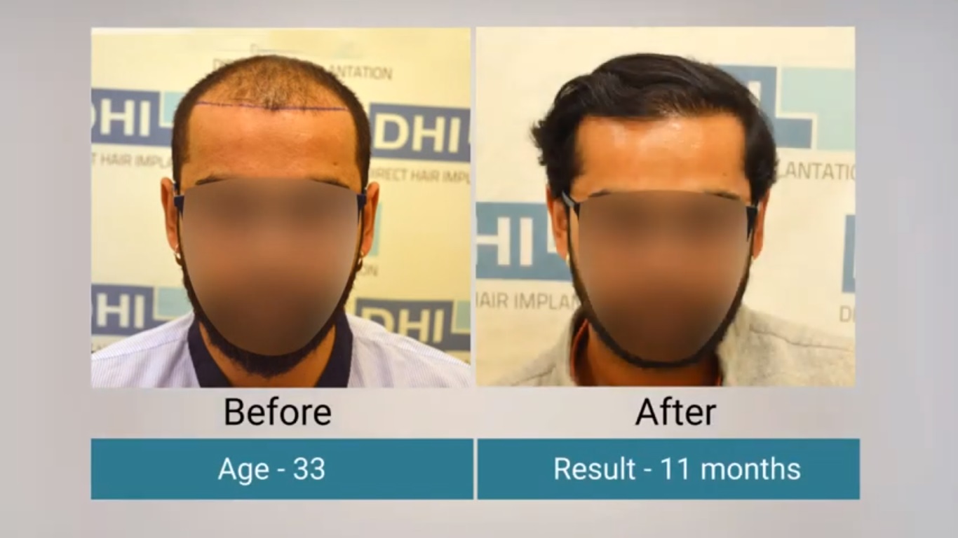 hair transplant video 1