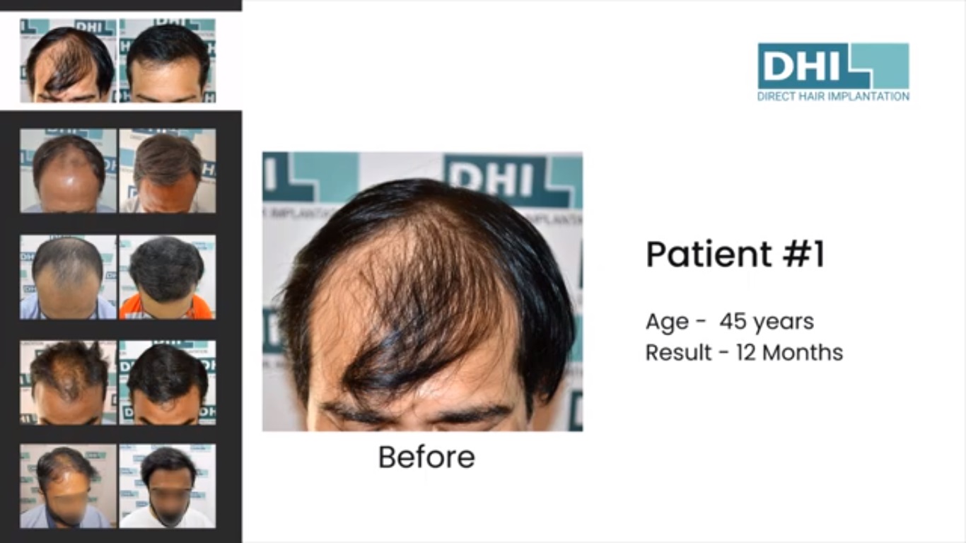 hair transplant video 1