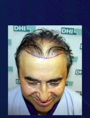 hair transplant video 1