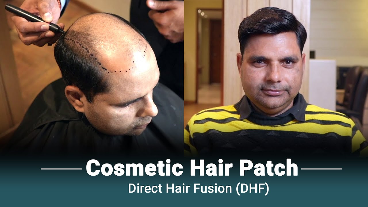 hair transplant video 1