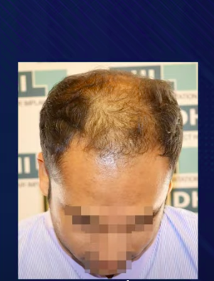 hair transplant video 1