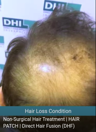 hair transplant video 1