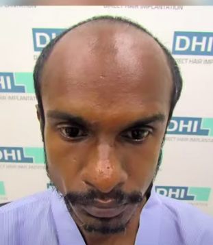 hair transplant video 1