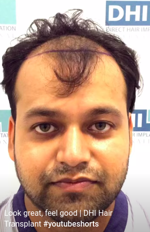 hair transplant video 1