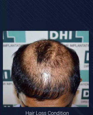 hair transplant video 1