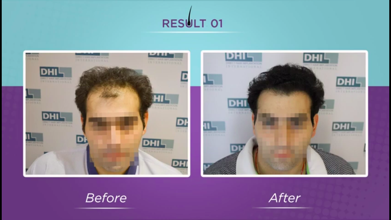 hair transplant video 1