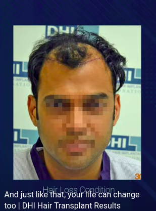 hair transplant video 1