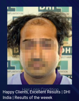 hair transplant video 1